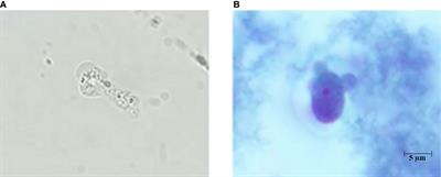 The First Molecular Genotyping of Naegleria fowleri Causing Primary Amebic Meningoencephalitis in Thailand With Epidemiology and Clinical Case Reviews